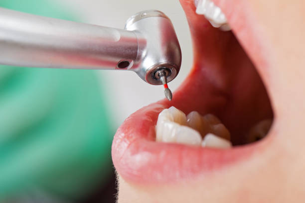 Best Emergency Tooth Extraction in Middlesborough, KY
